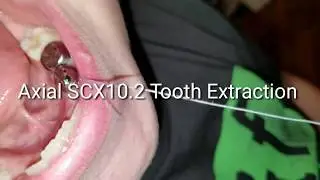 How to Pull a Tooth Using a Axial Scx10.2 Tooth Extraction Must Watch!