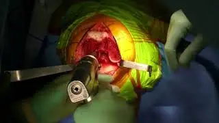 Total Knee Replacement Surgery Video | Conformis