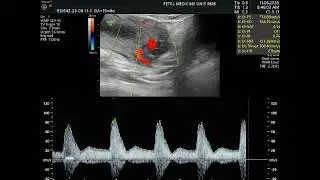 uterine artery Doppler in pregnancy