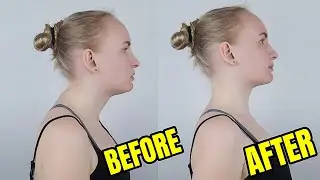 5 Ways to Get Rid of Your Buffalo Hump Naturally!