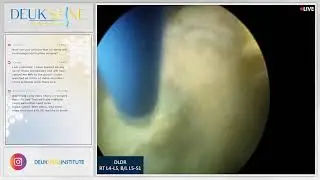 Laser Spine Surgery for Discogenic Lower Back Pain from Herniated Disc L4-L5, L5-S1