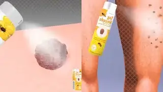 flysmus Tag Recede Bee Venom Treatment Spray for All Skin Types Review 2024