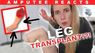 Amputee Reacts to LEG TRANSPLANT!? (This is ACTUALLY Real!)