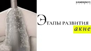 Этапы развития АКНЕ. Acne development stages 