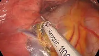 Uniportal Right Thoracoscopic upper lobectomy