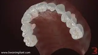 One-Piece implant supported Dental Prosthesis - Bone Level attachment