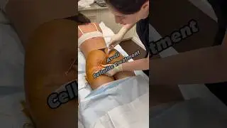 Get rid of cellulite w/ Aveli 🍑⚠️TW⚠️ #aveli #cellulite #trending  #shorts #reels #drgunsandneedles