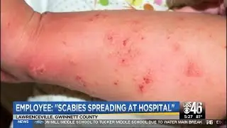 Scabies spreading at Lawrenceville hospital