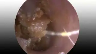 Removing Ear Wax