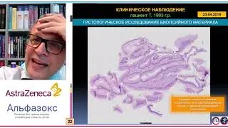 Рак пищевода Баррета у пациента 25 лет: клиническое наблюдение