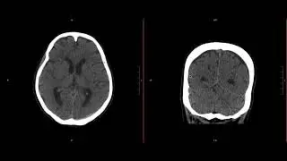 Neuroradiology Call Prep Cases: Acute Subdural Hematoma (CT) Case 10 Discussion
