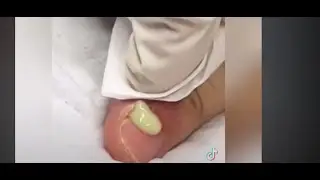 Pimple & Blackhead Popping |  Tiktok Compilation