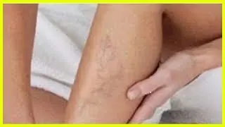 Советы при нарушении кровообращения