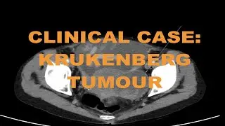 Clinical case - Metastatic cholangiocarcinoma (cancer) on CT abdomen - How to read and diagnose.