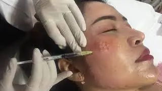 ลิฟโหนก โหนกแก้ม โหนกใหญ่