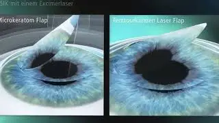 FEMTO-LASIK 7D I Eyelaser Wien & Zürich
