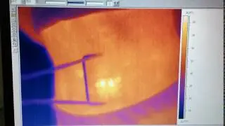 Láseres Fotona - TightSculpting con T-Runner - Termografia