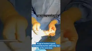 Hallux Limitus or Big Toe Joint Arthritis | Implant by Dr. Kevin Lam #toppodiatrist #halluxlimitus
