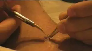 stitches...
