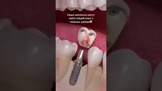 Наши импланты могут найти общий язык с любыми зубами