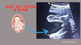 Baby boy lets out jet of urine in womb | Ultrasound
