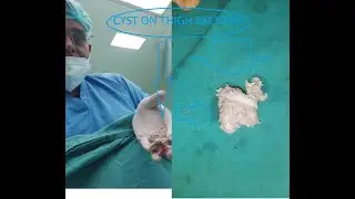 Cyst On Thigh Excision