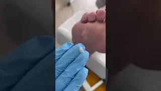 Tirar calos dos pes #calos #calosidade #pedicure