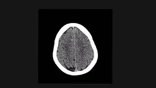 How to figure out non-traumatic causes of intracranial bleeding