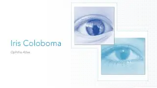 Iris Coloboma