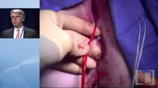 Difficult to Manage Perianal Fistulae and Abscesses in Crohn’s Disease Patients