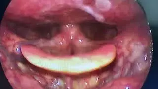 #vocal #cord #cysts can cause your voice to sound raspy, breathy, or hoarse