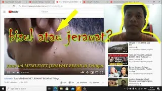 jerawat batu terbesar [Reaction] satisfying
