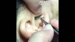 看看人家是怎样挤黑头的