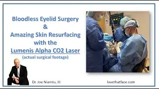 Advanced Laser Resurfacing and Blepharoplasty with the Lumenis Alpha CO2 Laser