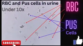 RBC and Pus cells in urine | RBC under microscope | Pus cells | 