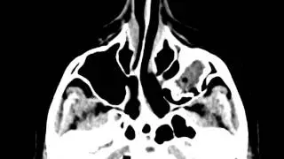 Odontogenic Ossifying Fibroma