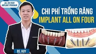 Chi phí trồng răng giả toàn hàm là bao nhiêu | All on 4 implant program