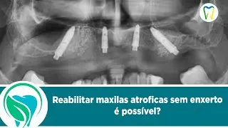 Maxilas Atróficas sem enxerto