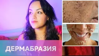 ДЕРМАБРАЗИЯ/СЖЕЧЬ КОЖУ И УМЕРЕТЬ ОТ НАРКОЗА?