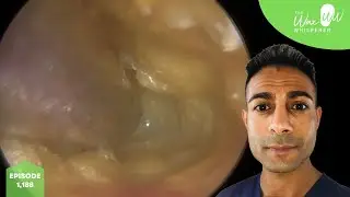 1,188 - Complex ‘Operation Game’ Ear Wax Removal