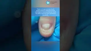 Удаление образования под ногтем  