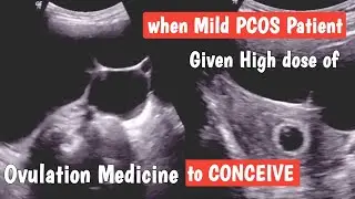 Multiple Ovarian Cysts + Early Pregnancy ( with Ovulation Medicines ) what is outcome ?