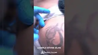 Lazerle Dövme Silme - Dr. Şerafettin Saraçoğlu | Nişantaşı Dermatolog