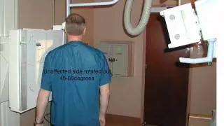 Supraspinatus outlet Neer.wmv