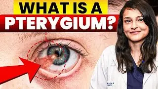 What Is A Pterygium? | Causes, Symptoms, And Treatments | Surfer Eye - Pterygium