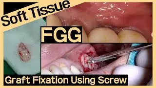 [Online Surgery] APF + FGG technique