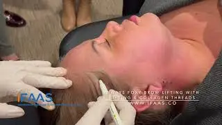 3 Ways Non-surgical Brow Lift with Barbed & Collagen Boosting Threads