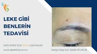 Leke Gibi Benlerin Tedavisi Nasıl Yapılır? - IDEA Klinik