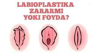 🔞Qin jarrohligi labioplastika zararlimi yoki foydali? Erkaklar kòrmasin