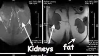 The Skinny On The Fat Gene